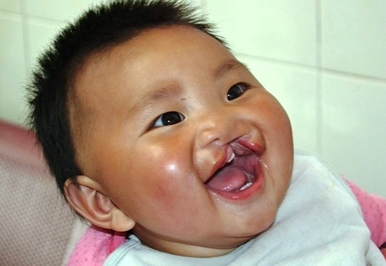 Baby girl with unilateral cleft lip laughing