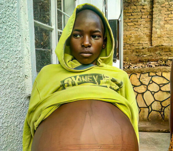 Girl with a green hoodie and a distended belly due to cancer