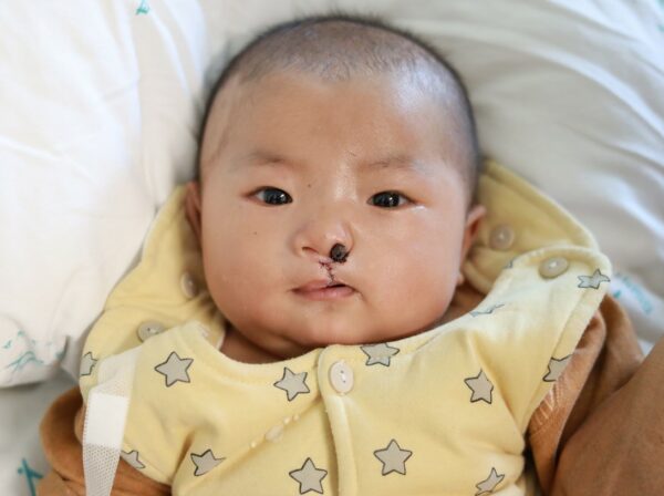 Baby in hospital wearing yellow and stars after cleft lip surgery