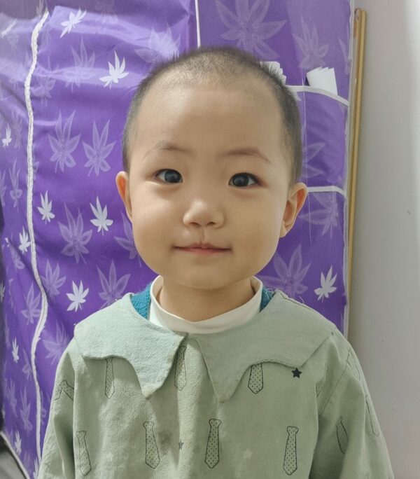 Boy with microform cleft lip in a green smock