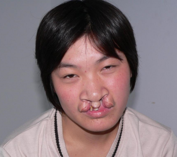 Teen girl with cleft lip