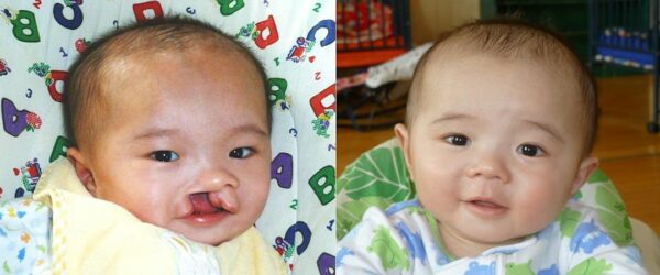 Side-by-side photos of twin boys, one of whom has cleft lip