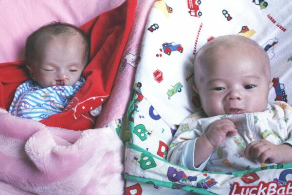 Twin baby boys, one with a cleft lip, lying side by side
