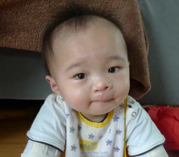 Baby boy in China with a repaired cleft lip