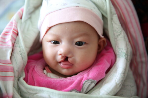 Baby girl in pink with a unilateral cleft lip