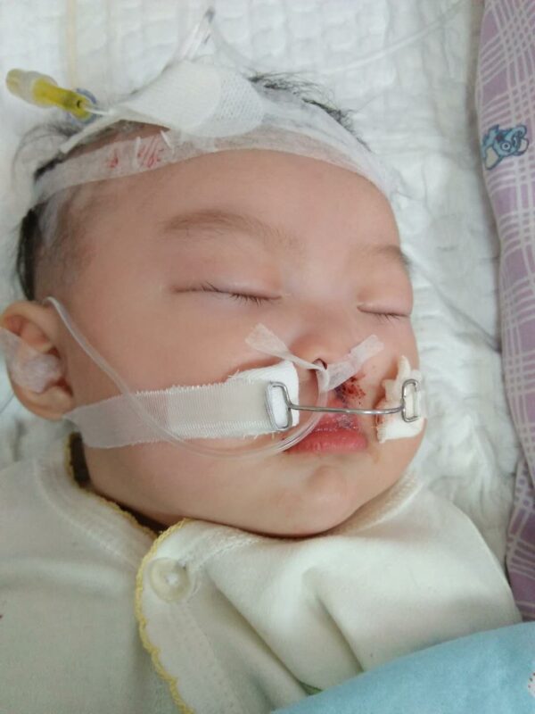 Baby in hospital following cleft lip repair surgery