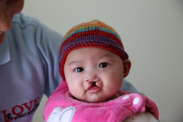 Baby girl with unilateral cleft lip wearing a rainbow hat