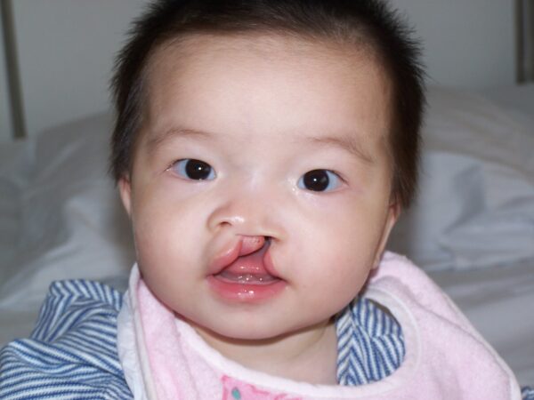 Baby with unilateral cleft lip wearing a pink bib