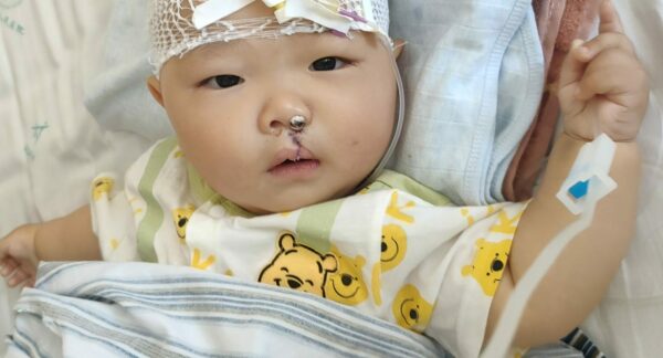 Baby in hospital following cleft lip repair
