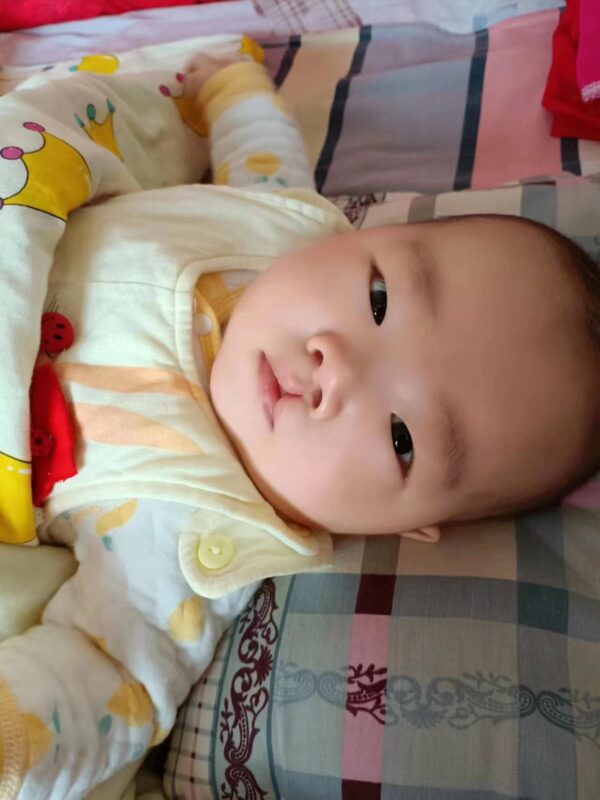 Baby in yellow with cleft lip