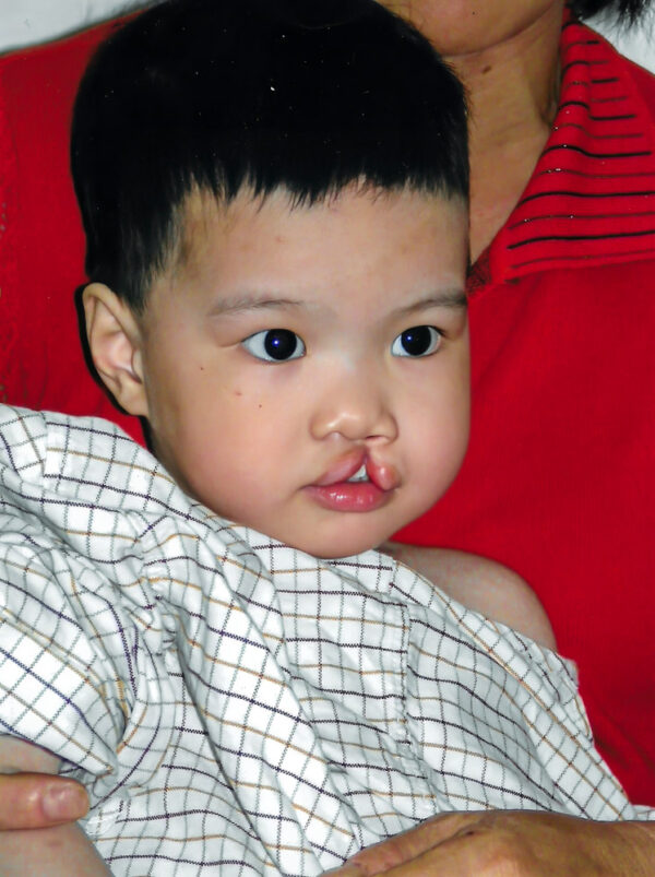 Toddler with unilateral cleft lip