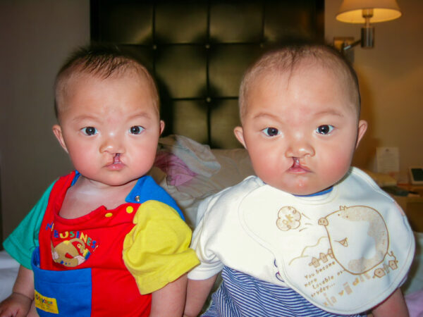 Twin girls with cleft lip