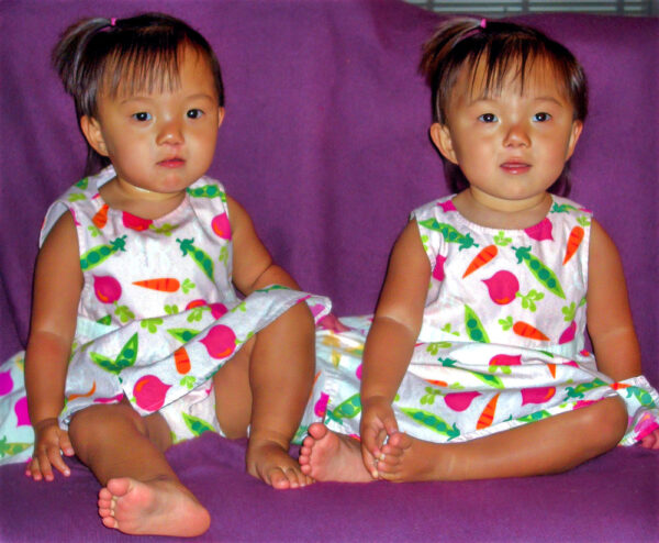 Toddler girls post cleft lip repair wearing matching dresses