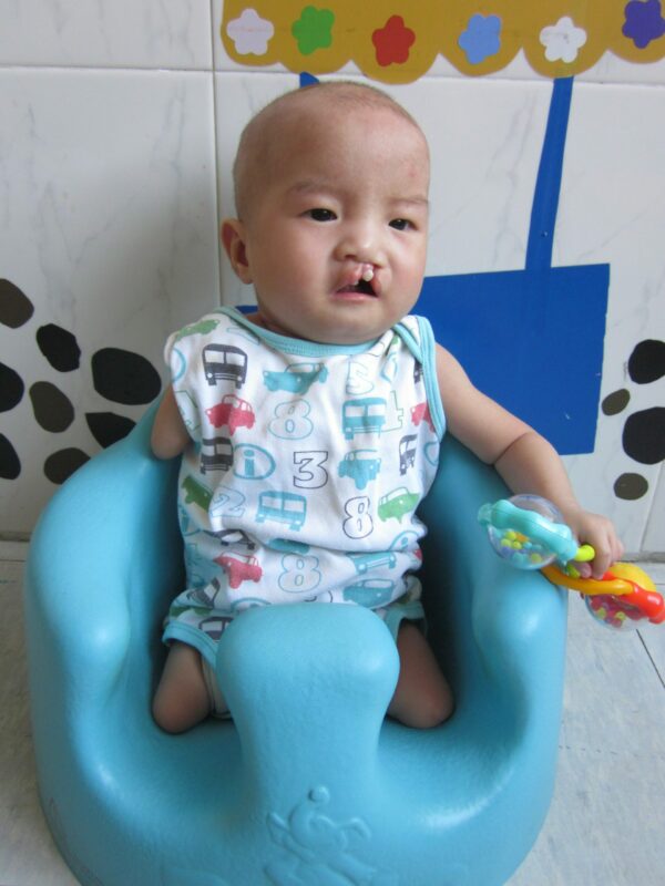 Baby girl with cleft lip and one arm in a baby seat