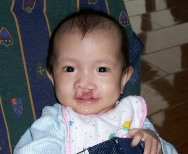 Boy with cleft lip 20 Years of Hope