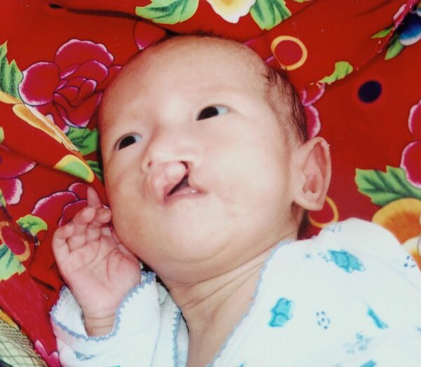 Newborn baby with cleft lip lying on a red flowered blanket