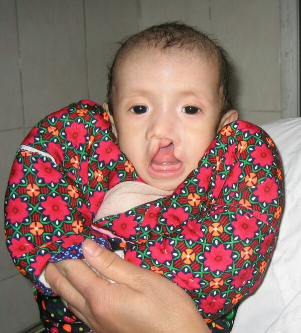 Newborn baby with cleft lip and palate in an orphanage