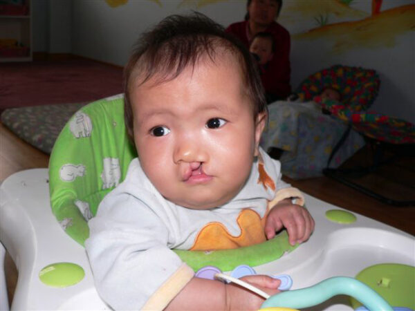 Baby boy with cleft lip in a walker