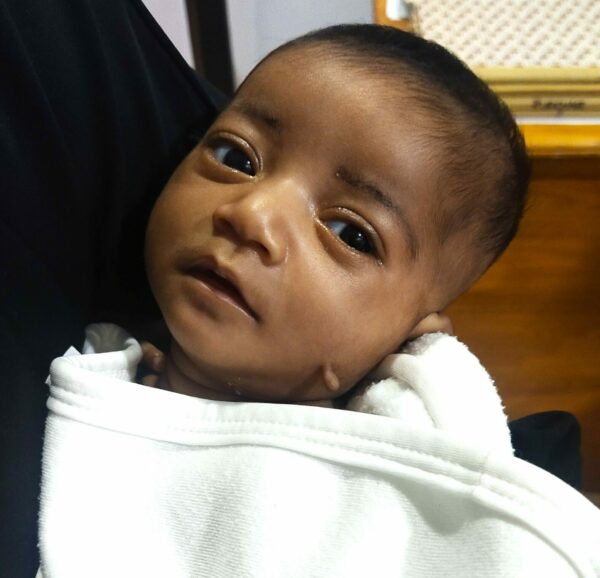 Newborn baby wrapped in a white blanket in need of heart surgery