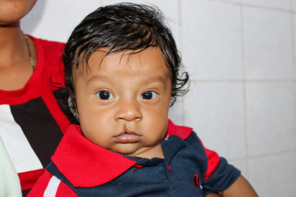 Baby boy with cleft lip