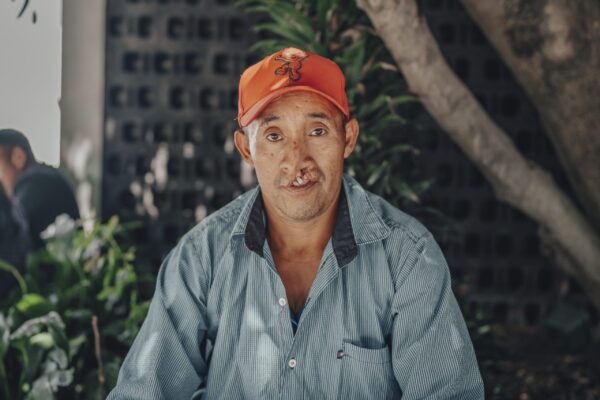 Man with cleft lip wearing and orange cap waits for cleft surgery