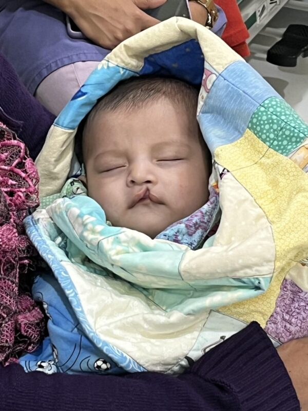 Baby with cleft lip wrapped in a blanket waits for surgery