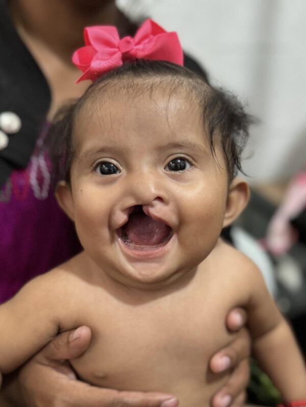 Baby girl with pink bow and cleft lip smiling
