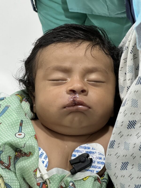 Baby sleeping in hospital after cleft repair surgery