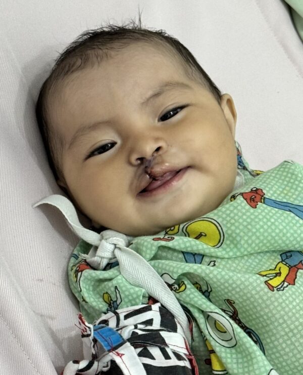 Baby girl smiling post cleft surgery
