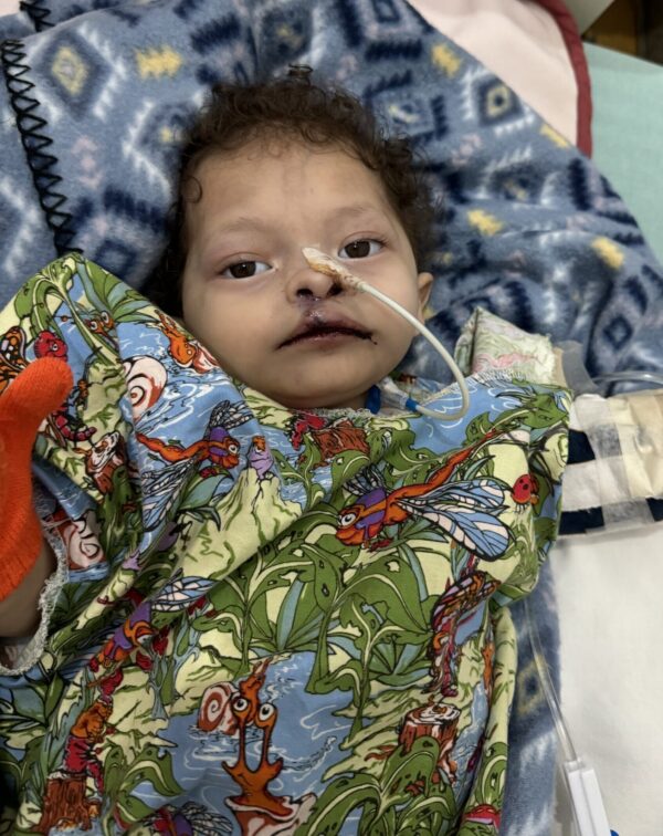 Tiny baby in hospital for cleft repair surgery