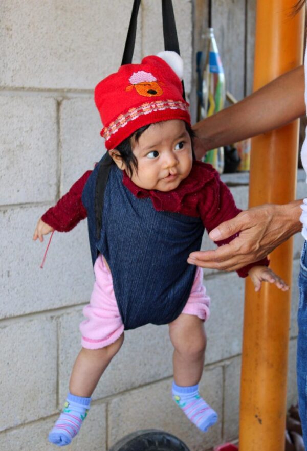 Baby in a red hat getting weighed before cleft repair surgery