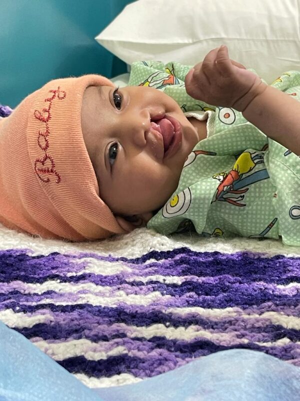 Baby in an orange cap with unilateral cleft lip lying on a purple and white blanket