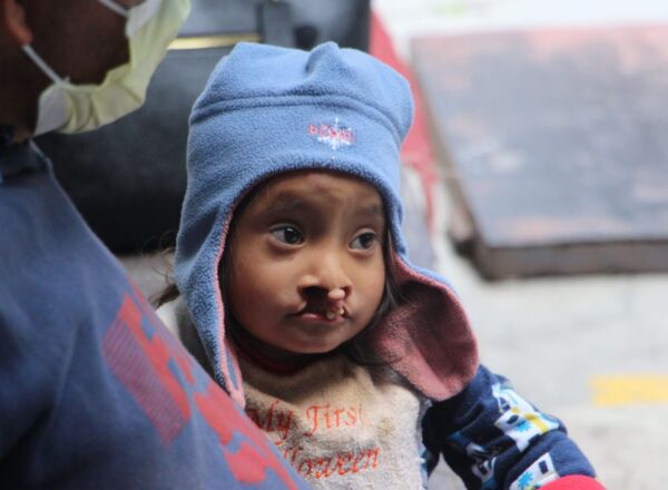 Child with a wide cleft wearing a blue winter hat