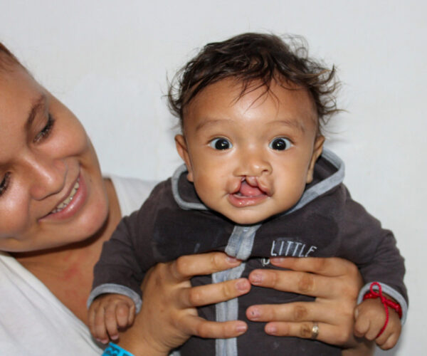 Baby with cleft lip held by his mom in Guatemala