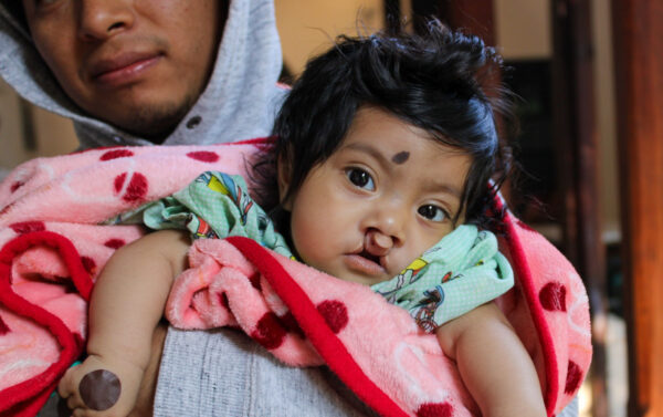 Girl with bilateral cleft lip