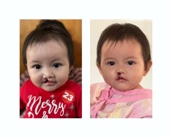 Girl before and after cleft surgery