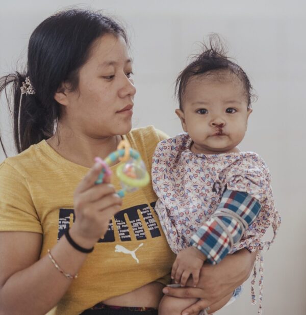 Baby boy and mom after cleft lip surgery