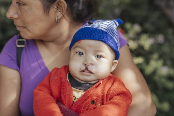 Baby boy with cleft lip
