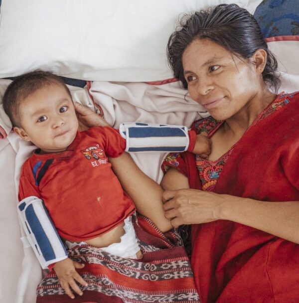 Boy and mom lying in hospital bed after his cleft repair surgery