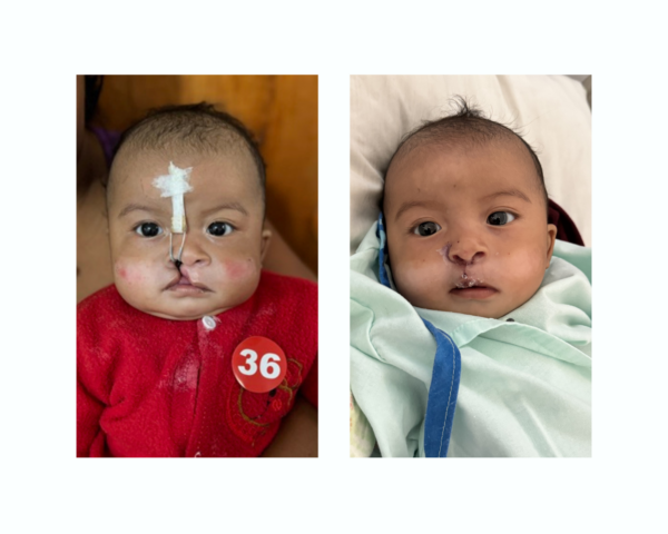 Boy before and after cleft surgery