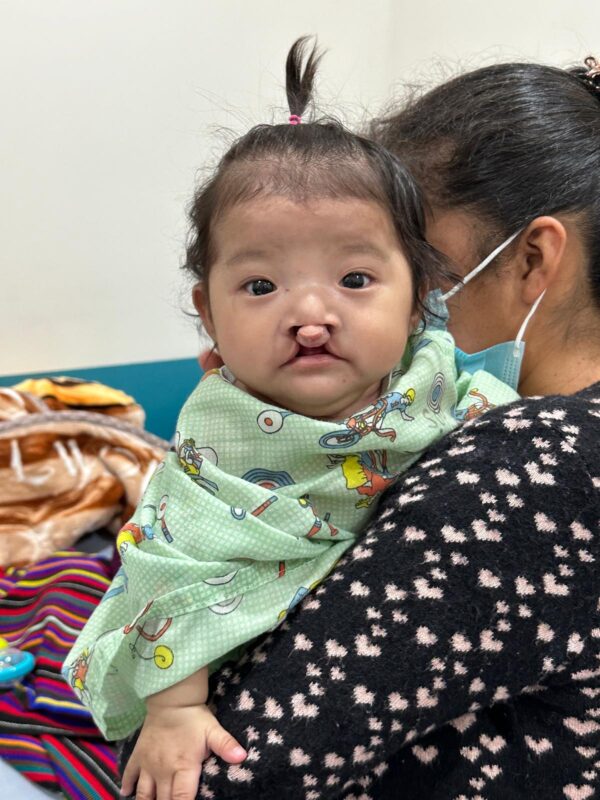Girl with cleft lip in hospital
