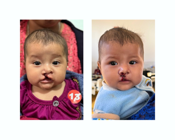 Girl before and after cleft surgery