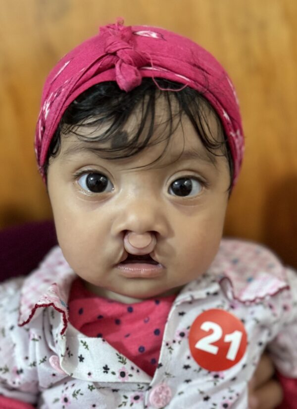 Our 2024 Guatemala Cleft Trip:  Day Four of Surgery