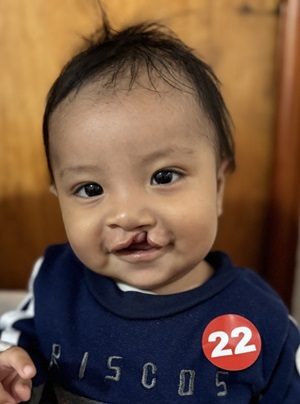 Baby boy with unilateral cleft lip