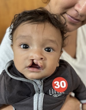 Baby boy with cleft lip waits for surgery