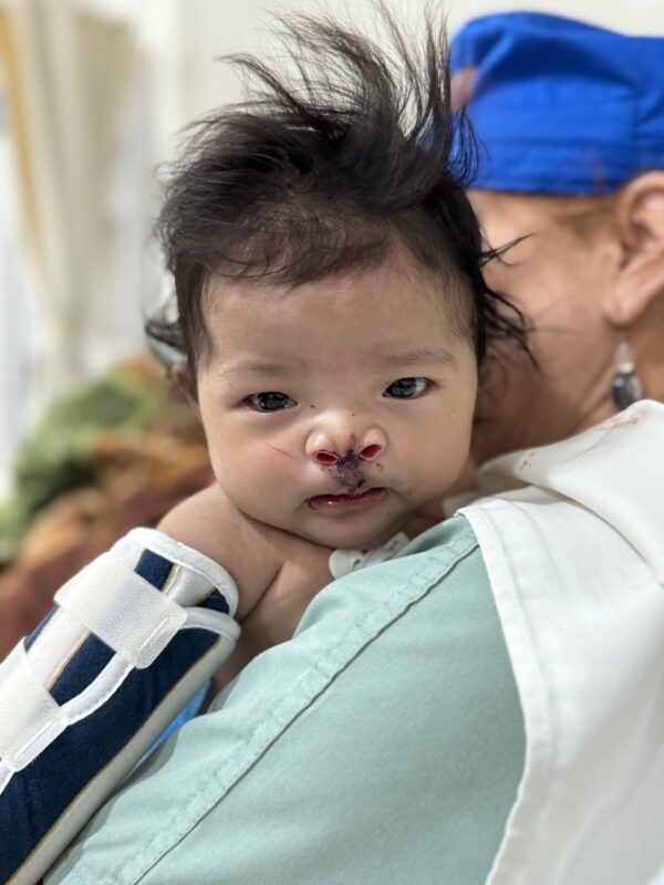 Baby girl after cleft surgery
