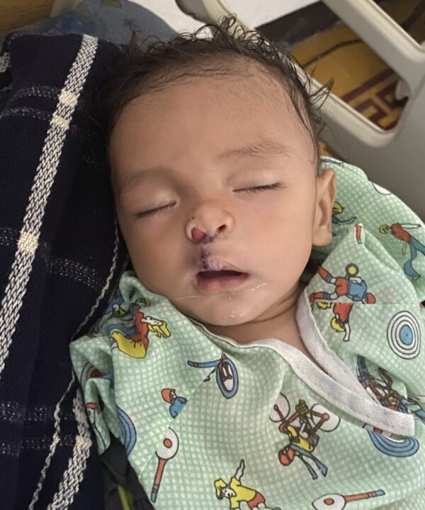 Baby recovering from cleft lip surgery