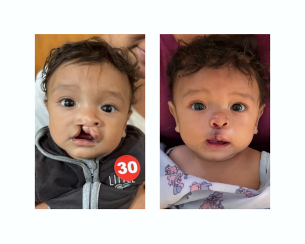 Boy before and after cleft surgery