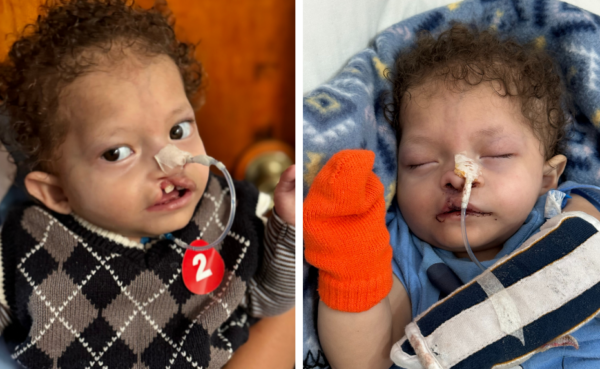 Boy before and after cleft repair surgery