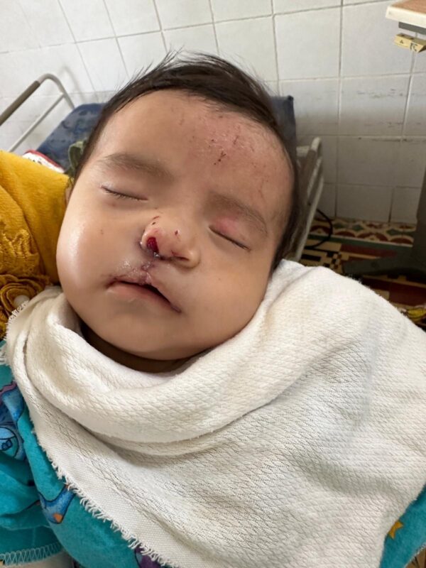Baby boy after cleft repair surgery